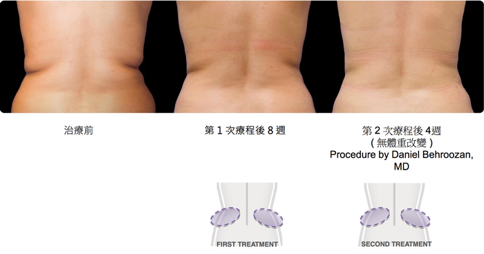 酷塑減脂前後對照