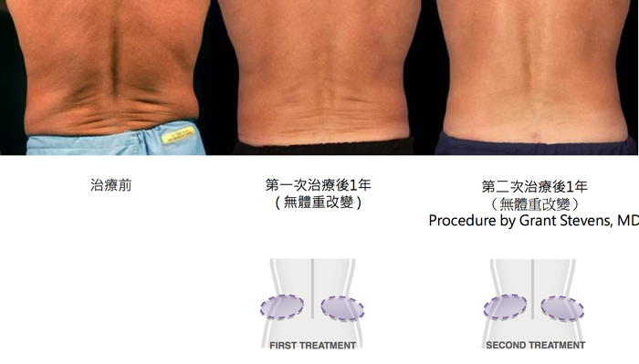 酷塑減脂前後對照