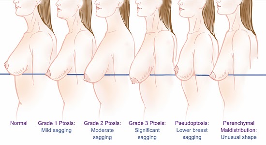 產後胸部下垂鬆弛好想哭！我該如何改善奶頭乳頭下垂？