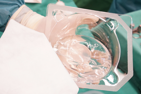 水滴胸手術過程-空腔撥離完成