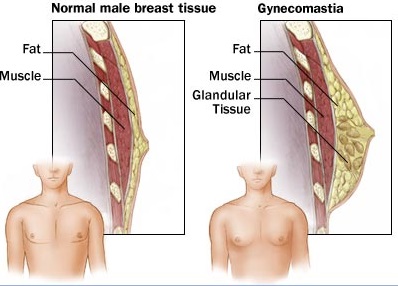 男性女乳症是什麼
