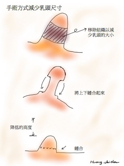 手術減少乳頭尺寸