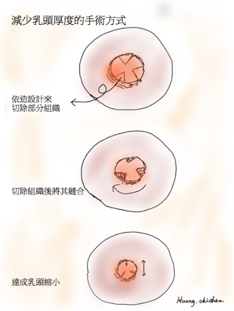 減少乳頭厚度的手術方式