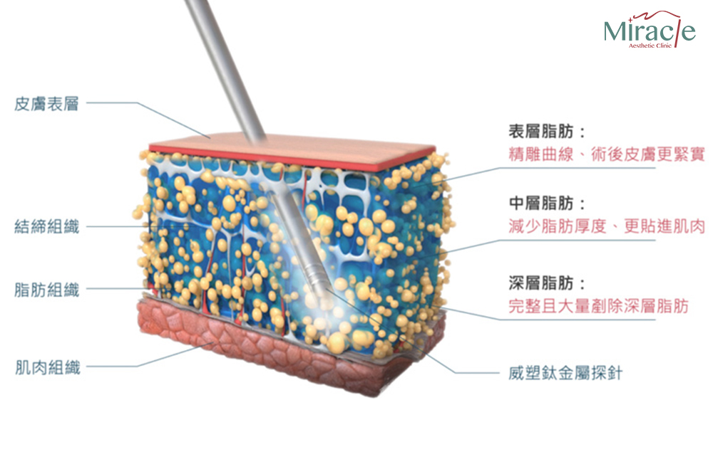 威塑抽脂作用原理