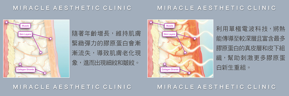 眼周輕齡除皺拉提原理