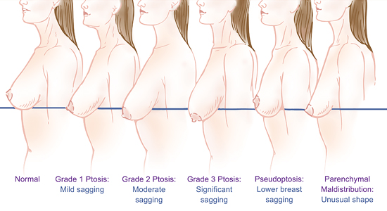 乳房下垂的分級