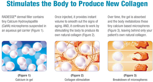 Radiesse mechanism of action
