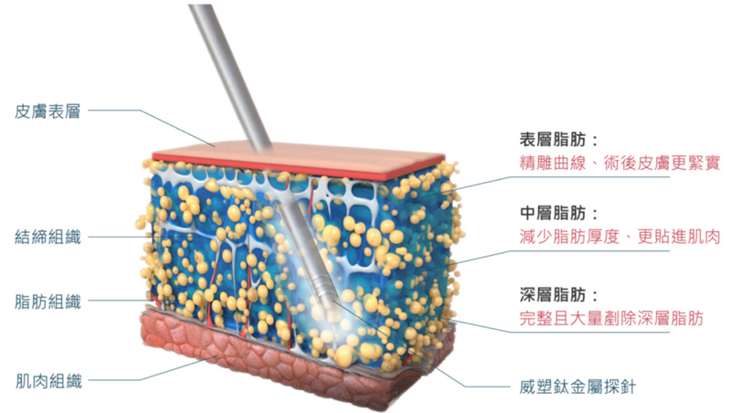 威塑抽脂圖解