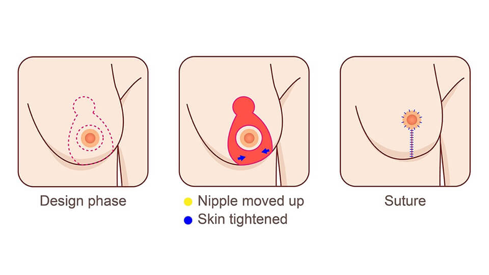 提乳手術推薦