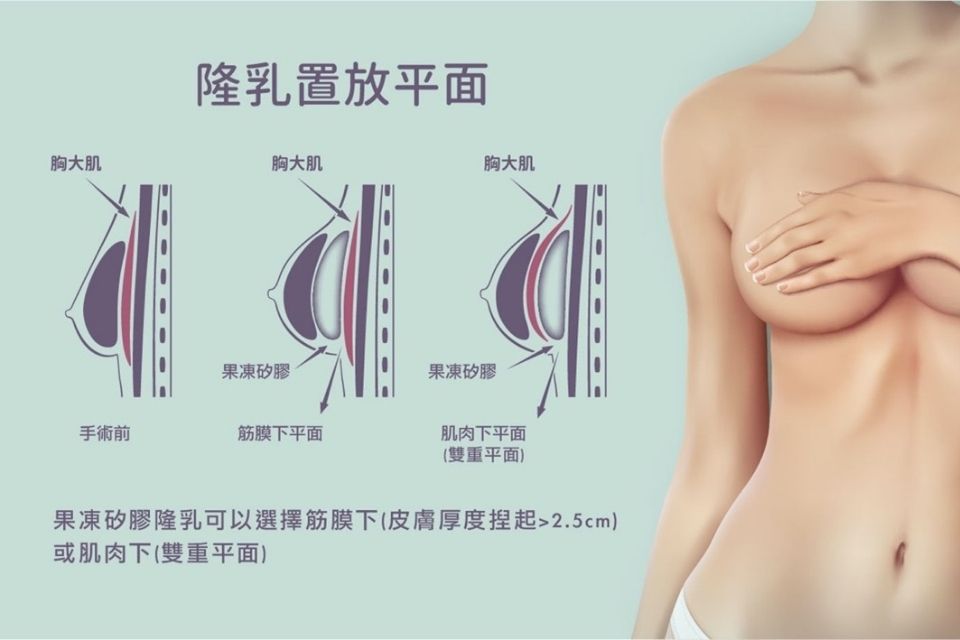 免按摩、無痛筋膜下隆乳｜專業醫師淺談筋膜下隆乳適合對象