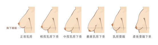 I型垂直切口縮胸手術