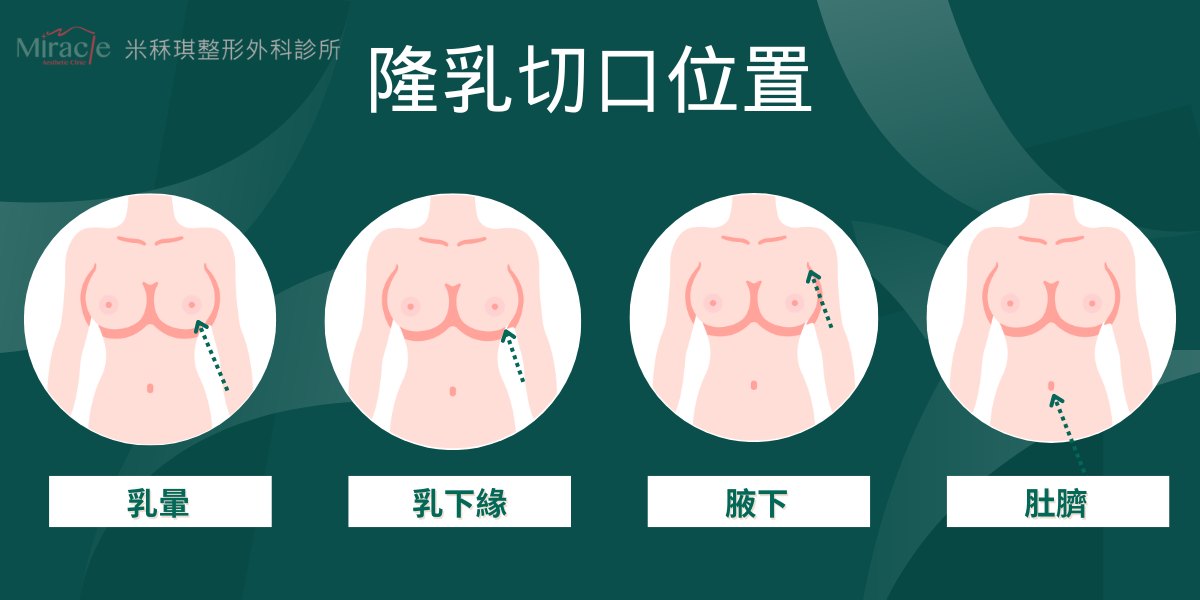 隆乳切口與假體擺放位置