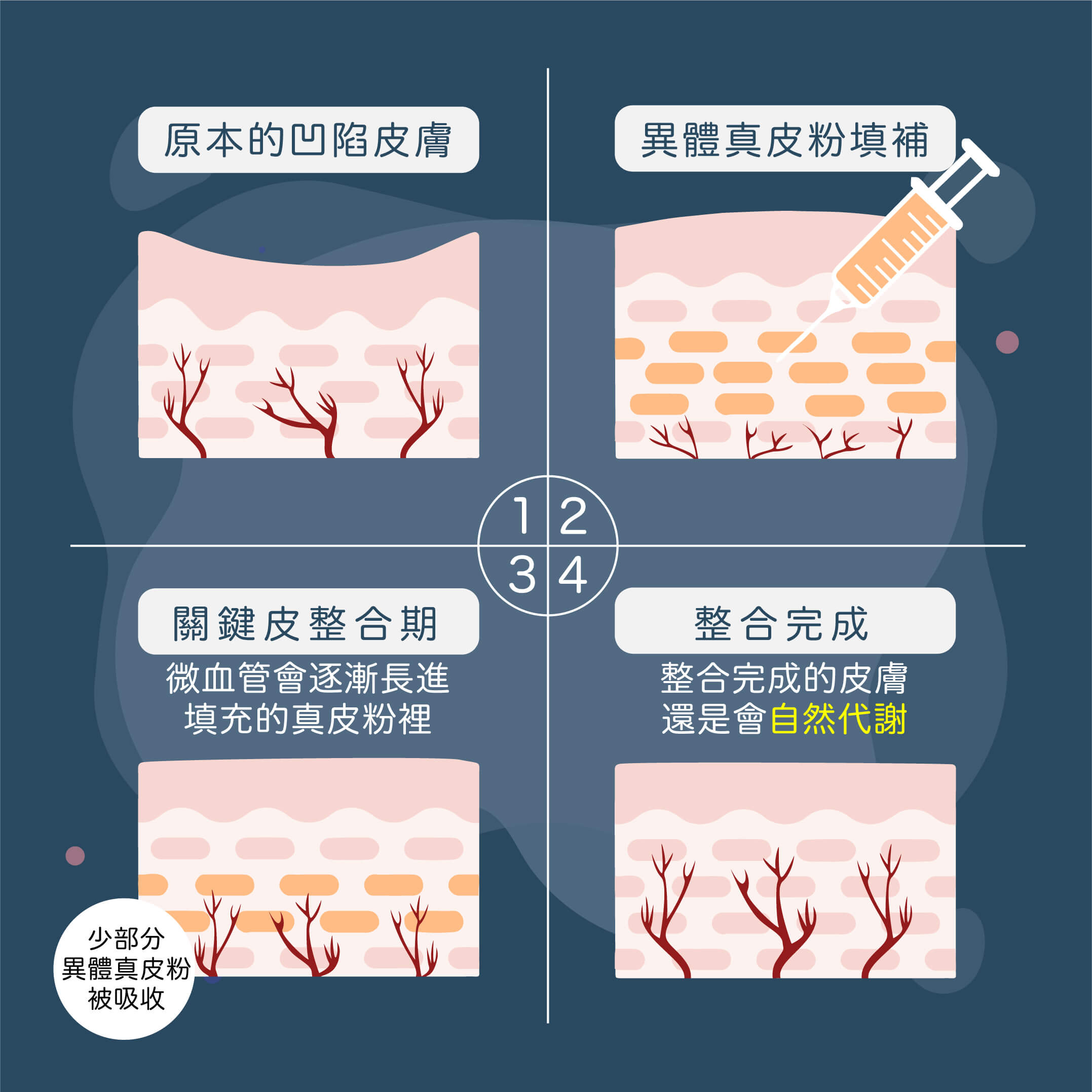 異體真皮粉施打流程