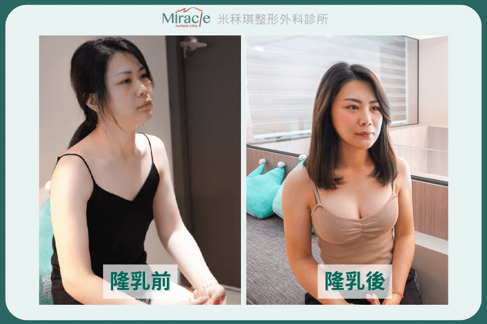 魔滴隆乳案例