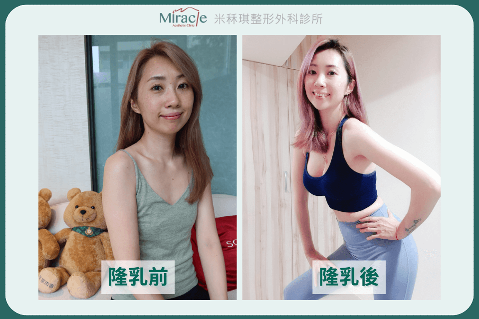 魔滴隆乳案例