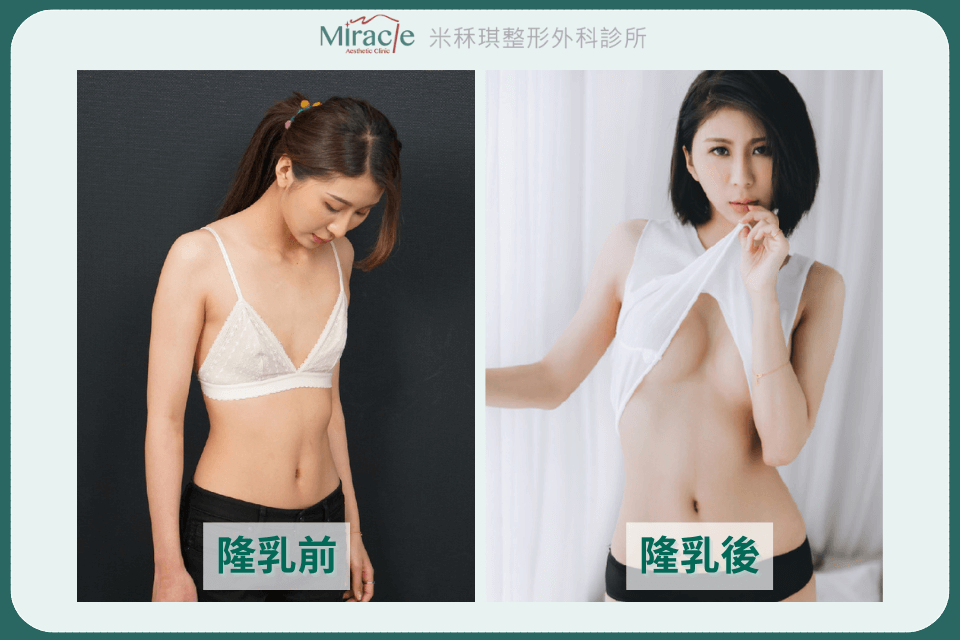 魔滴隆乳案例
