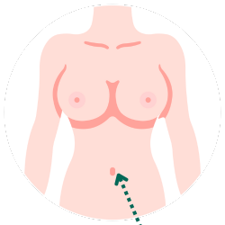 隆乳切口-肚臍示意圖