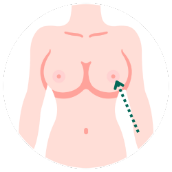 隆乳切口-乳暈示意圖