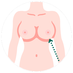 隆乳切口-乳下緣示意圖