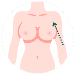 隆乳切口-腋下示意圖