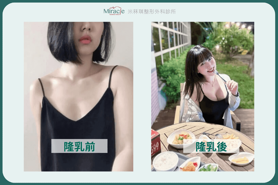 12年隆乳夢成真！魔滴隆乳